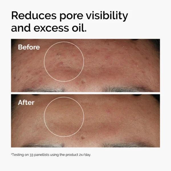ord-niacinamide-zinc-blemish-serum-before-after-pores.webp The Ordinary Niacinamide 10% + Zinc 1% – 30ml
